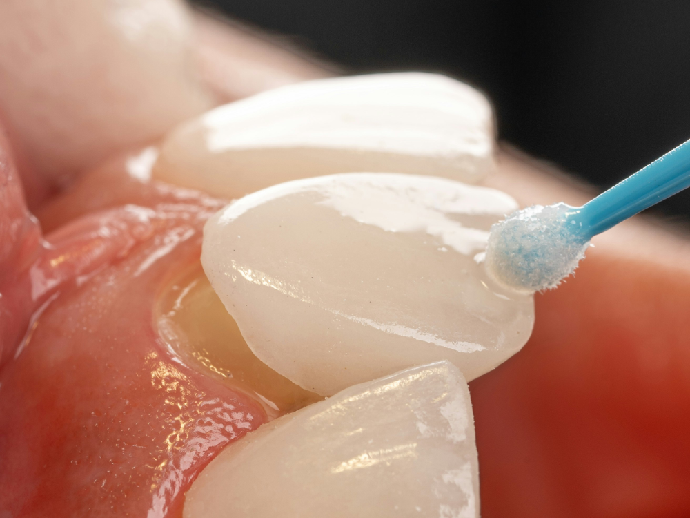 CASO 01: Lentes de contato dental